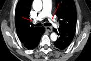 Computed Tomography Pulmonary Angiography for Evaluation of Patients With Suspected Pulmonary Embolism: Use or Overuse